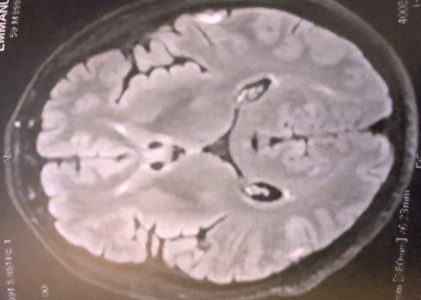 LE TUNNEL DANS LEQUEL MA CERVELLE SE CRAQUELLE