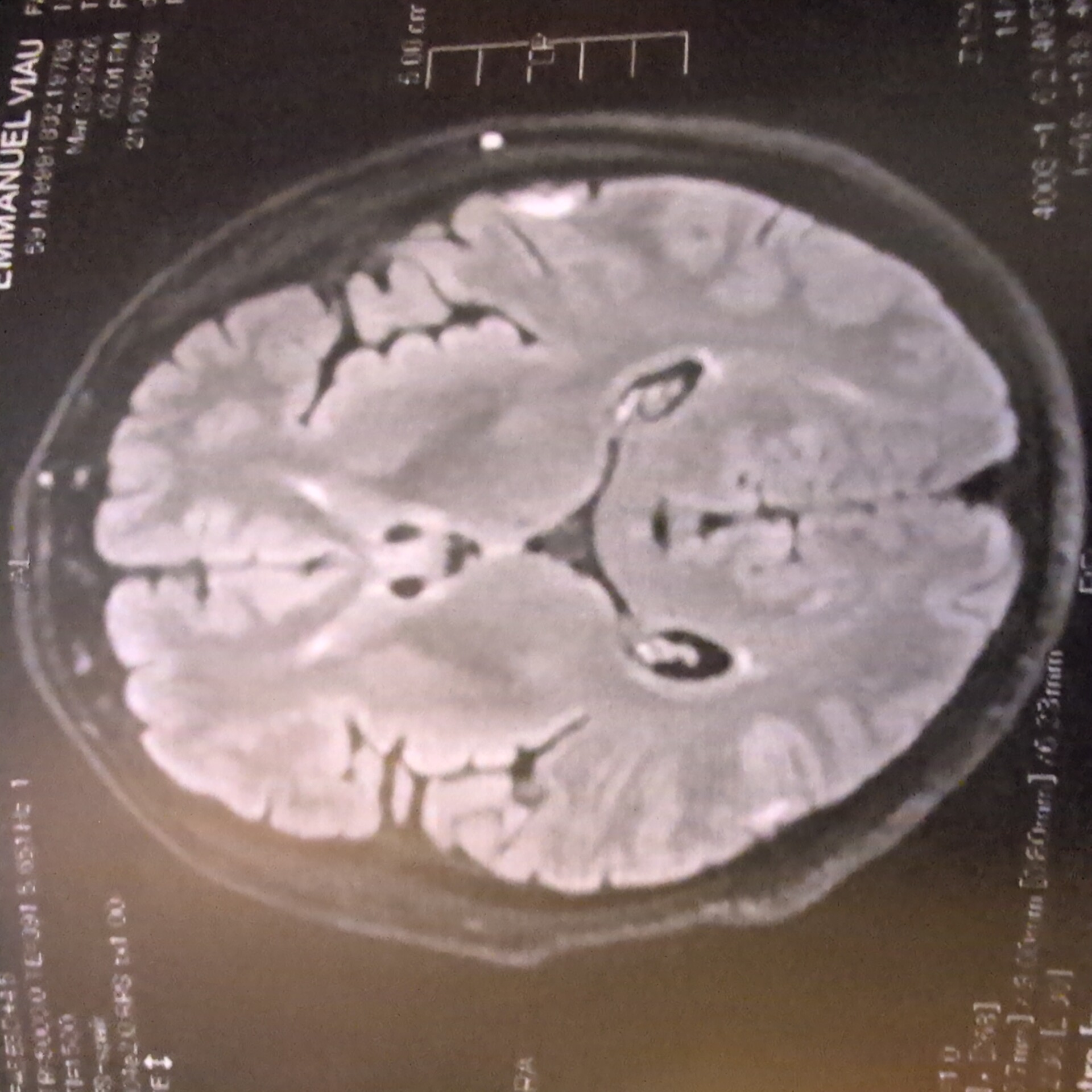 LE TUNNEL DANS LEQUEL MA CERVELLE SE CRAQUELLE